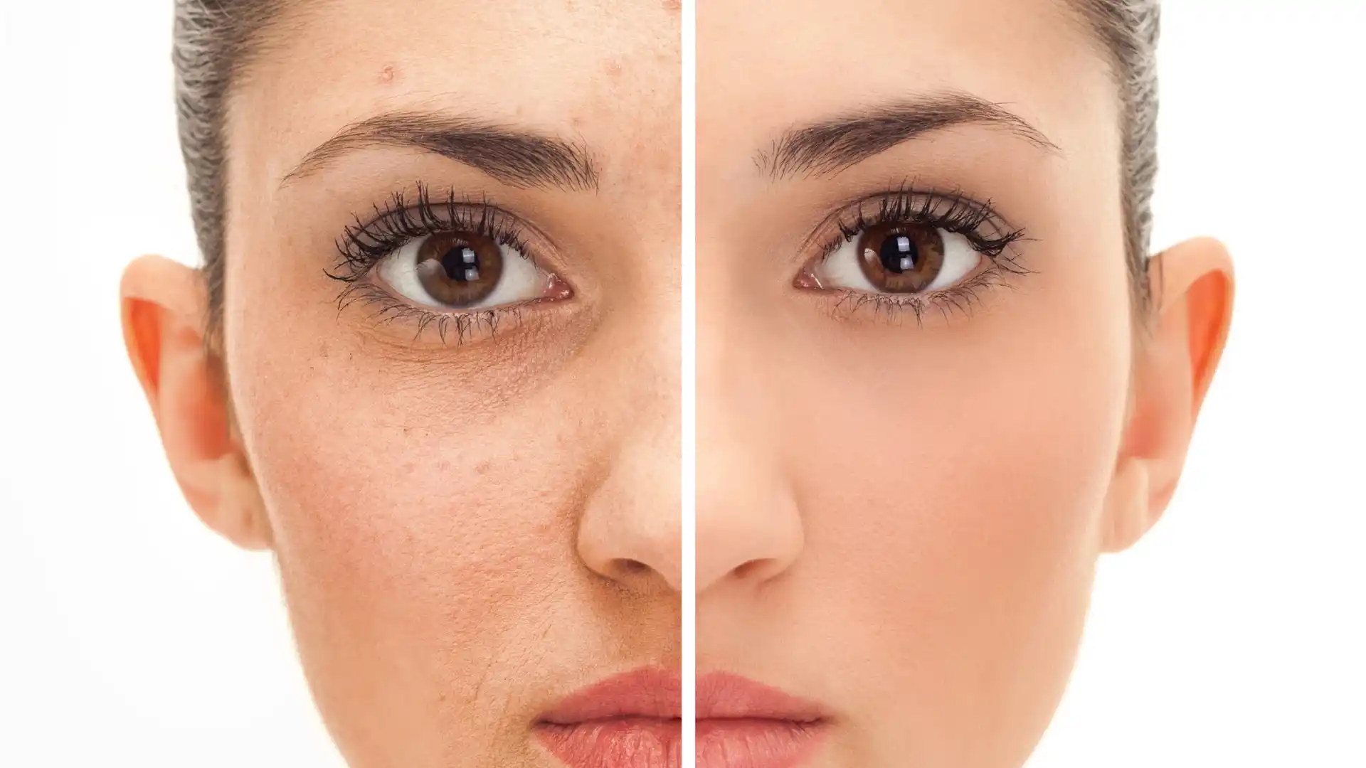 Acne Treatment by Whimsy Aesthetic Clinic