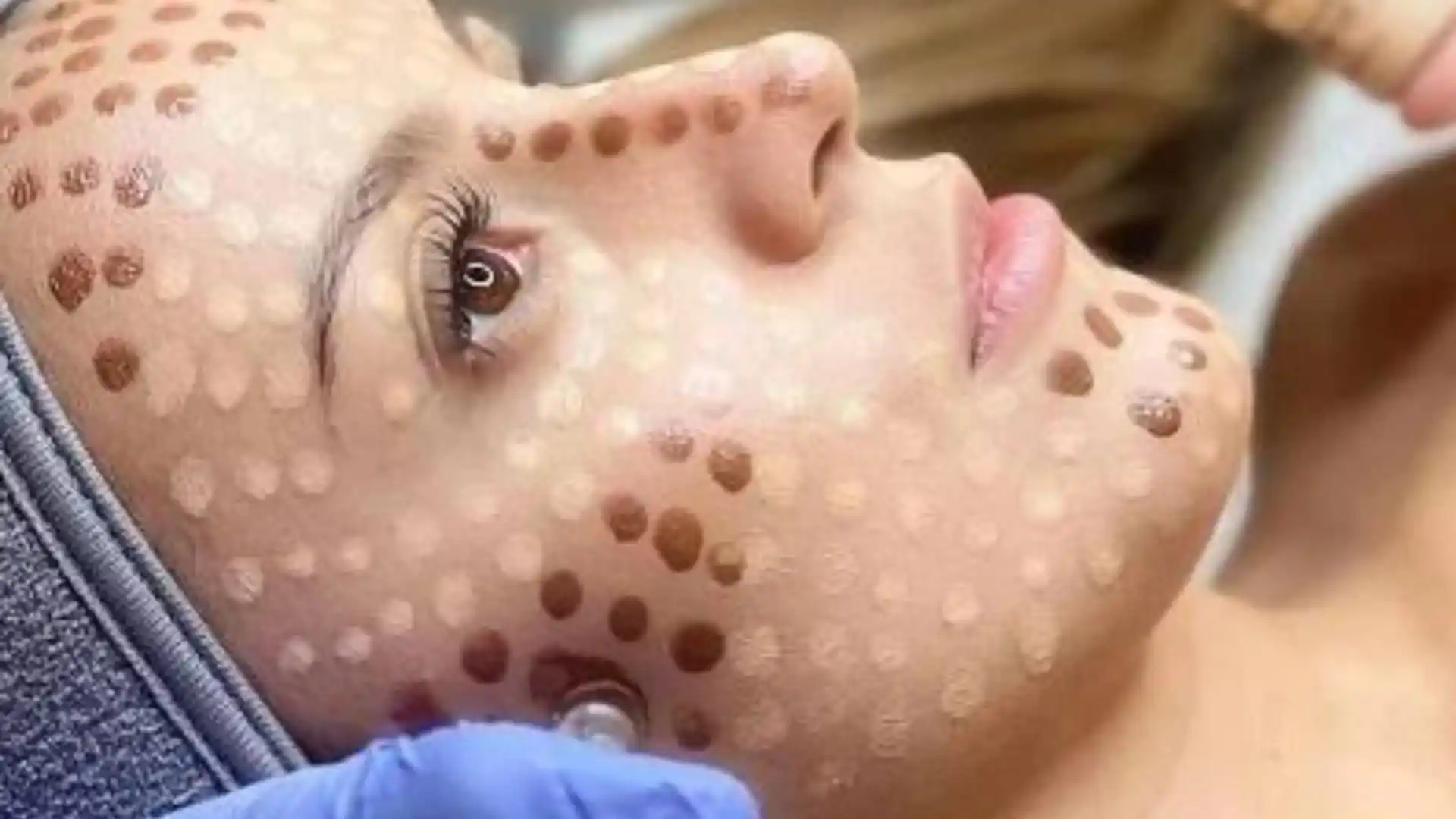 Bb glow treatment by Whimsy Aesthetic Clinic