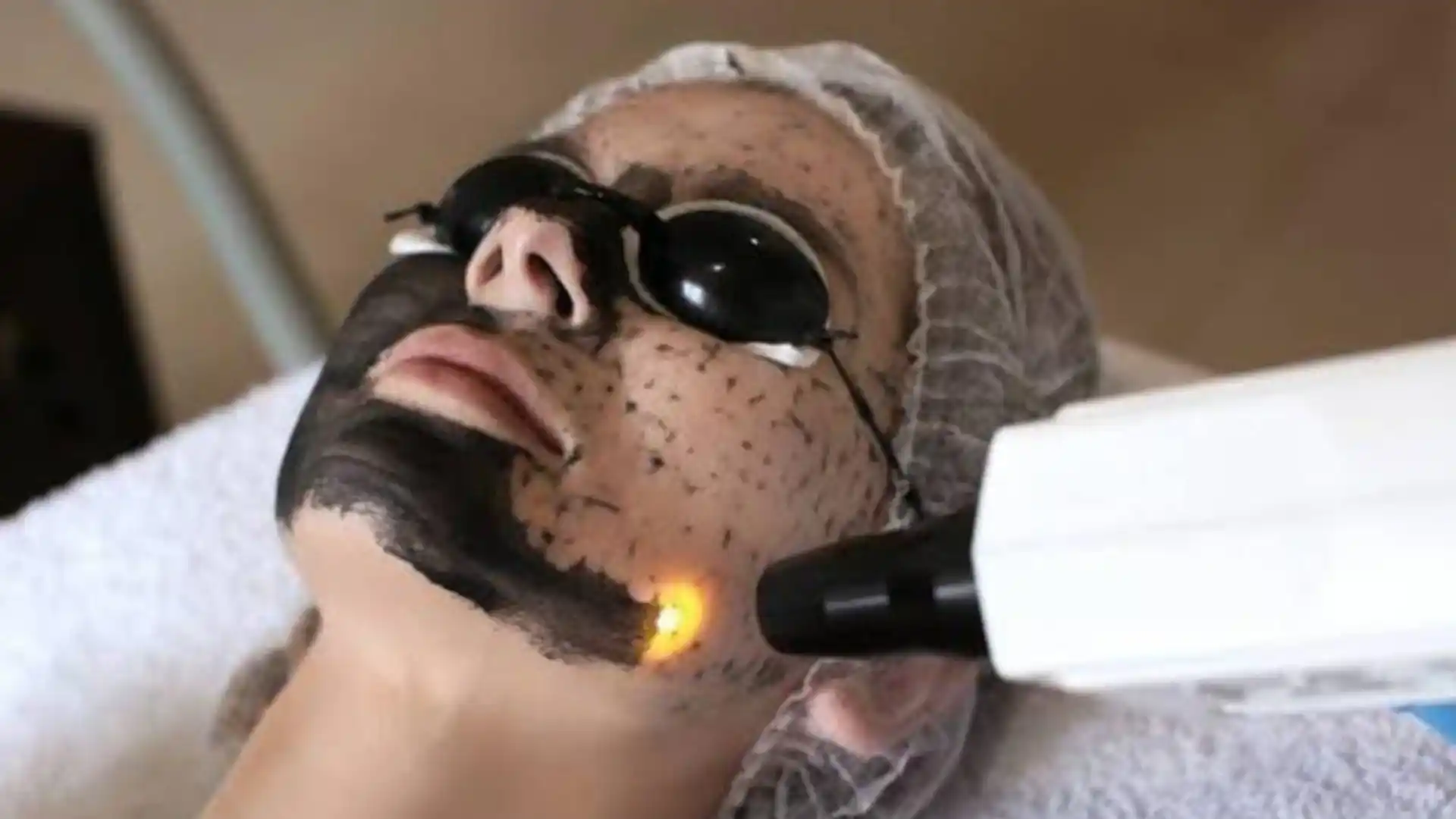 Carbon laser facial by Whimsy Aesthetic Clinic