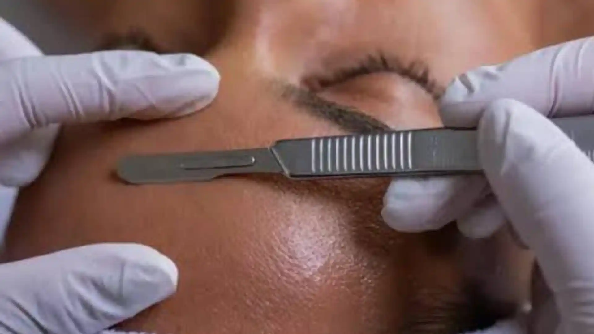 Dermaplaning by Whimsy Aesthetic Clinic