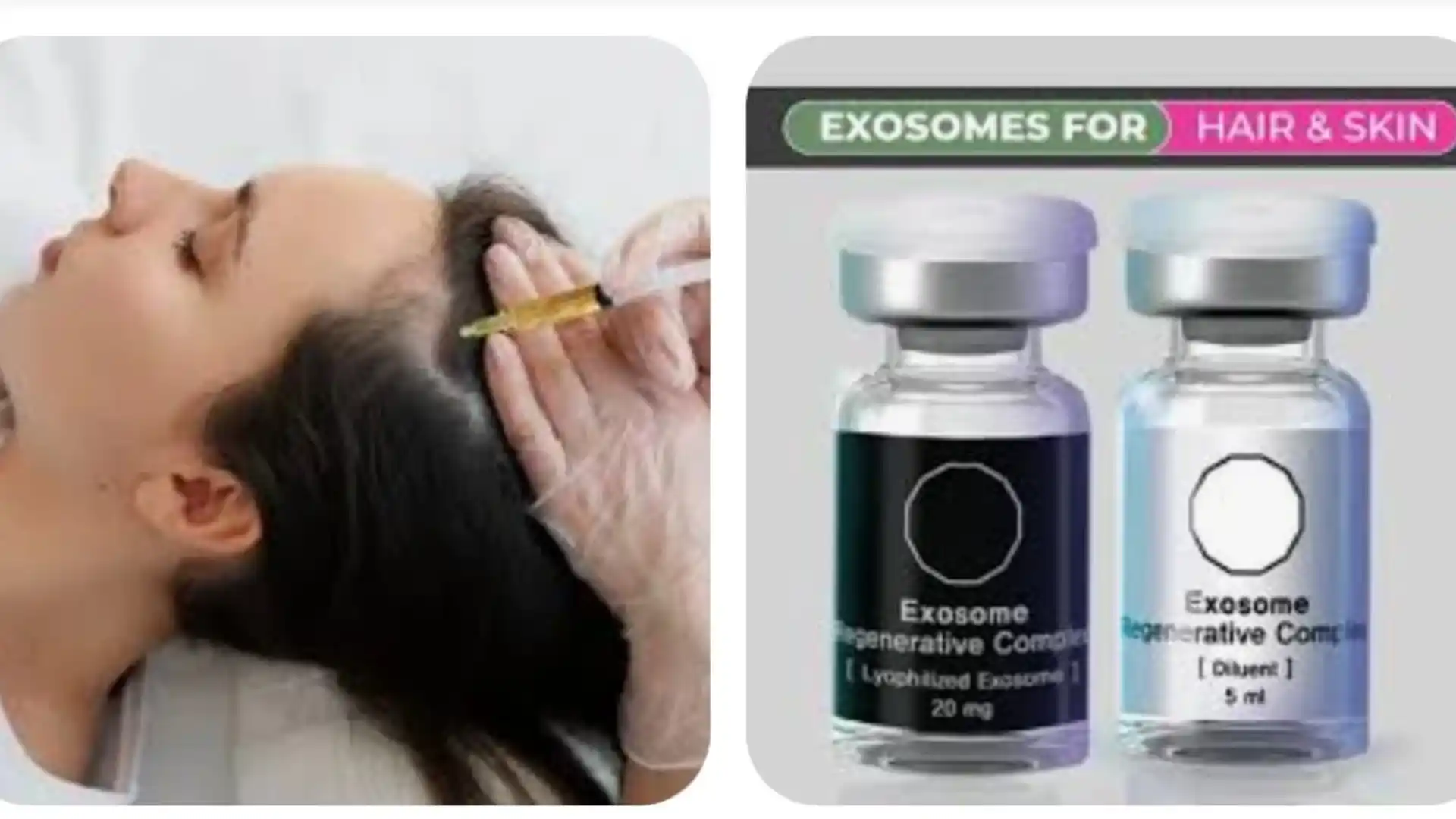 Exozomes by Whimsy Aesthetic Clinic