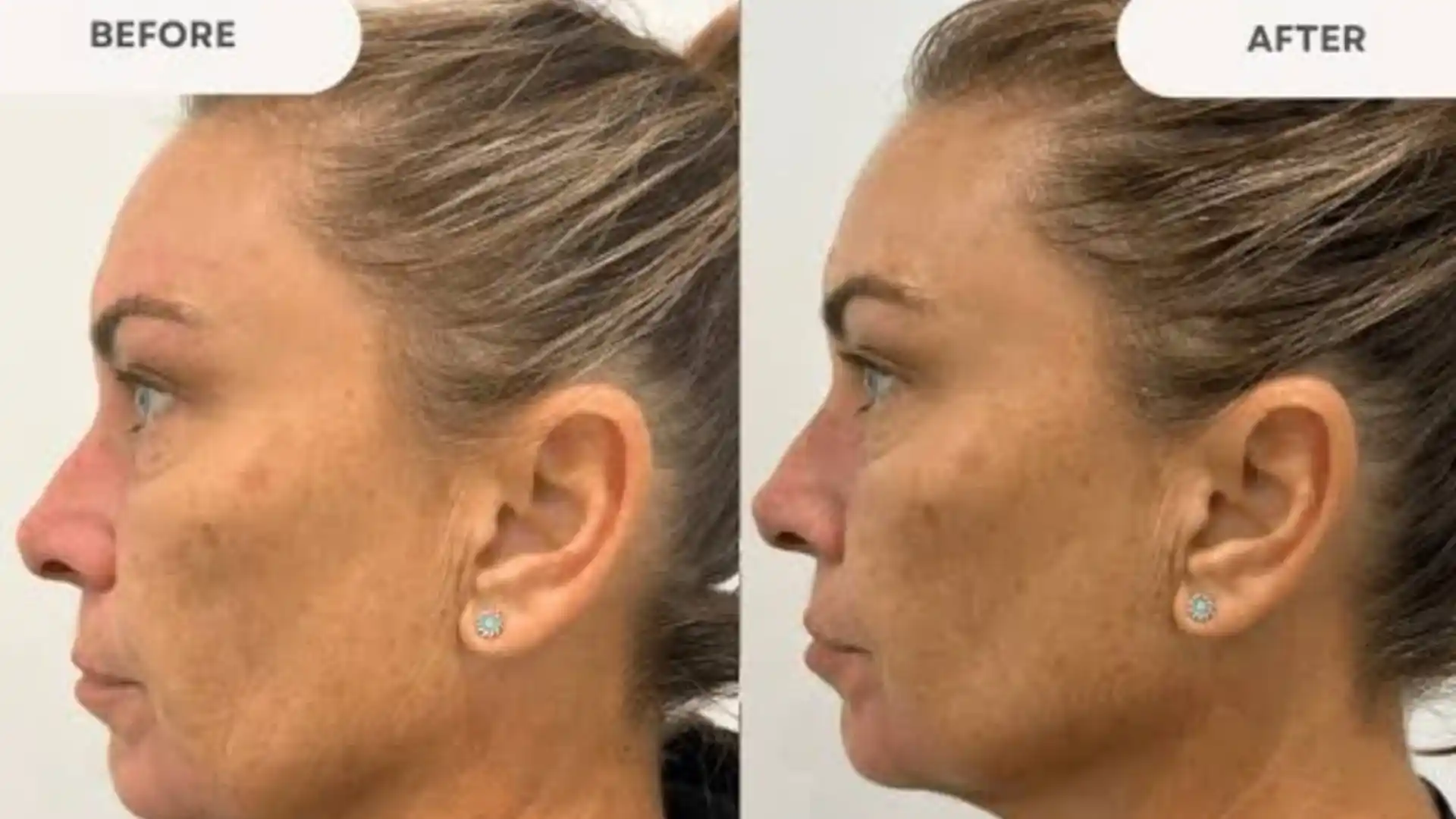 HIFU BEFORE AND AFTER by Whimsy Aesthetic Clinic