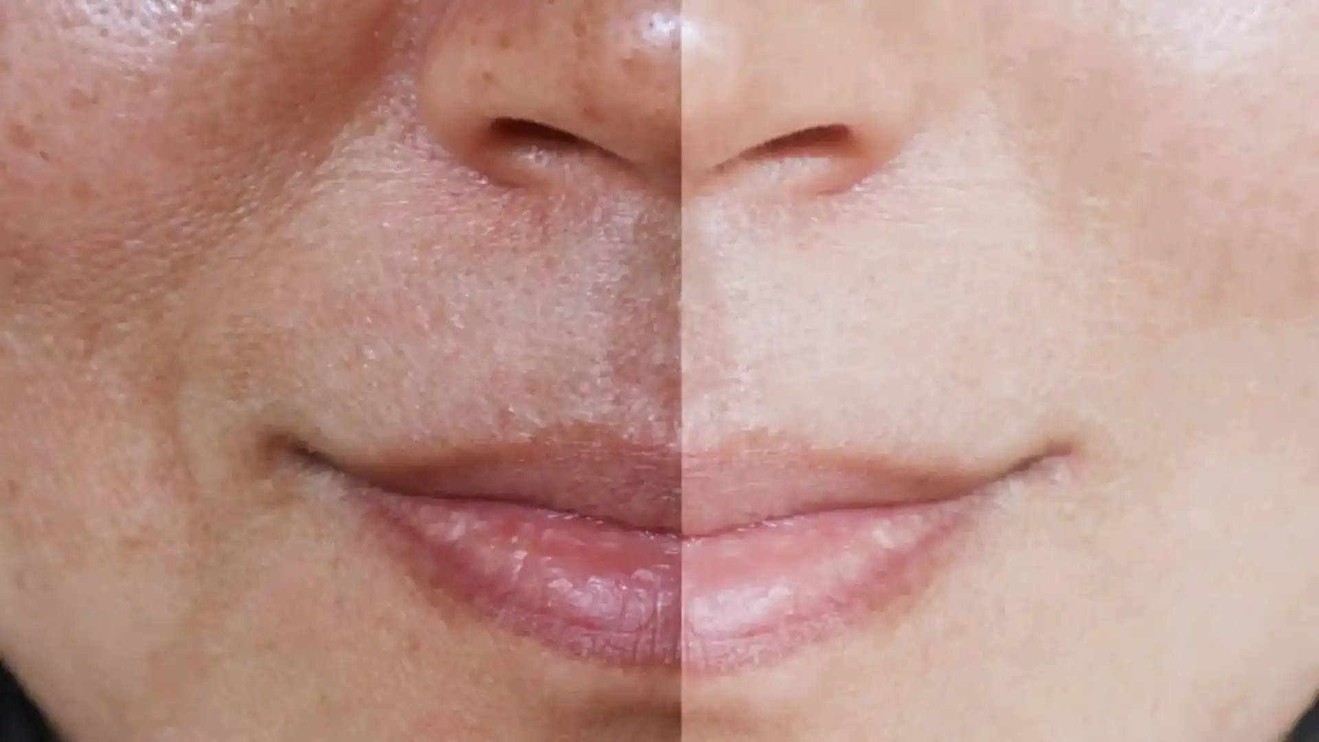 Laser for Open Pores by Whimsy Aesthetic Clinic