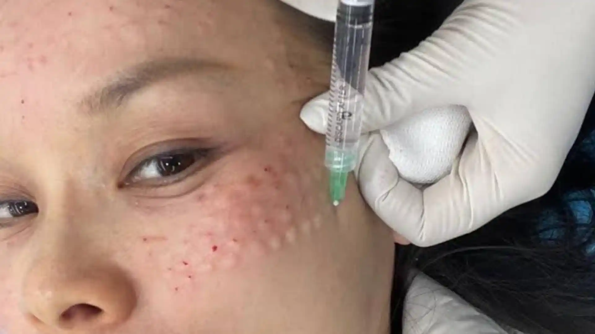 Mesotherapy by Whimsy Aesthetic Clinic