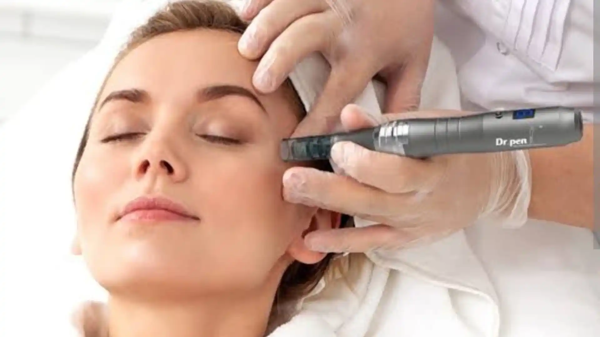 Microneedling by Whimsy Aesthetic Clinic