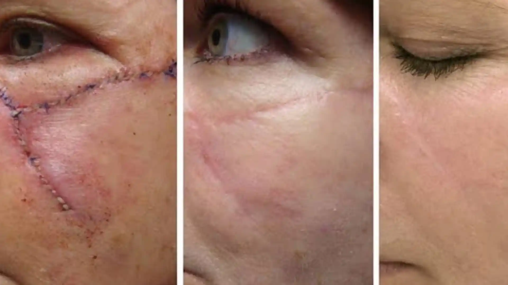Scar removal by Whimsy Aesthetic Clinic