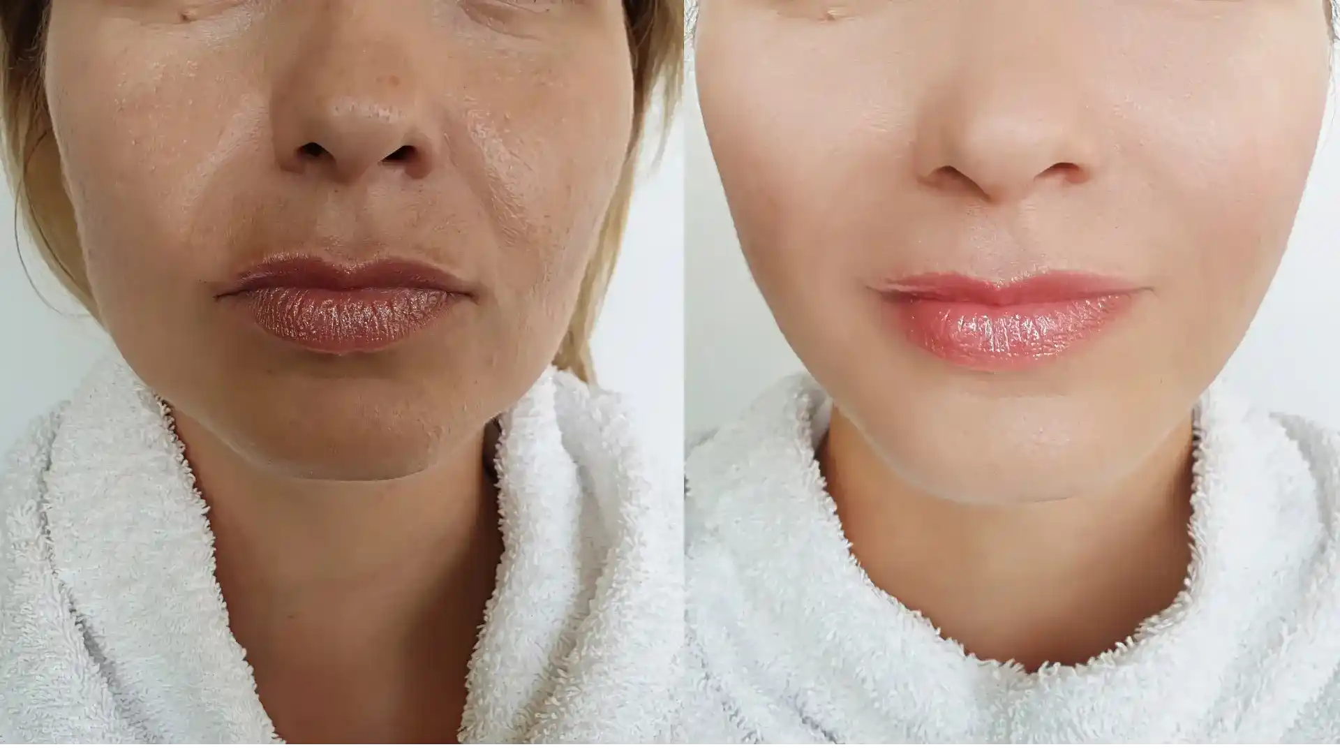 Stretch mark Reduction by Whimsy Aesthetic Clinic
