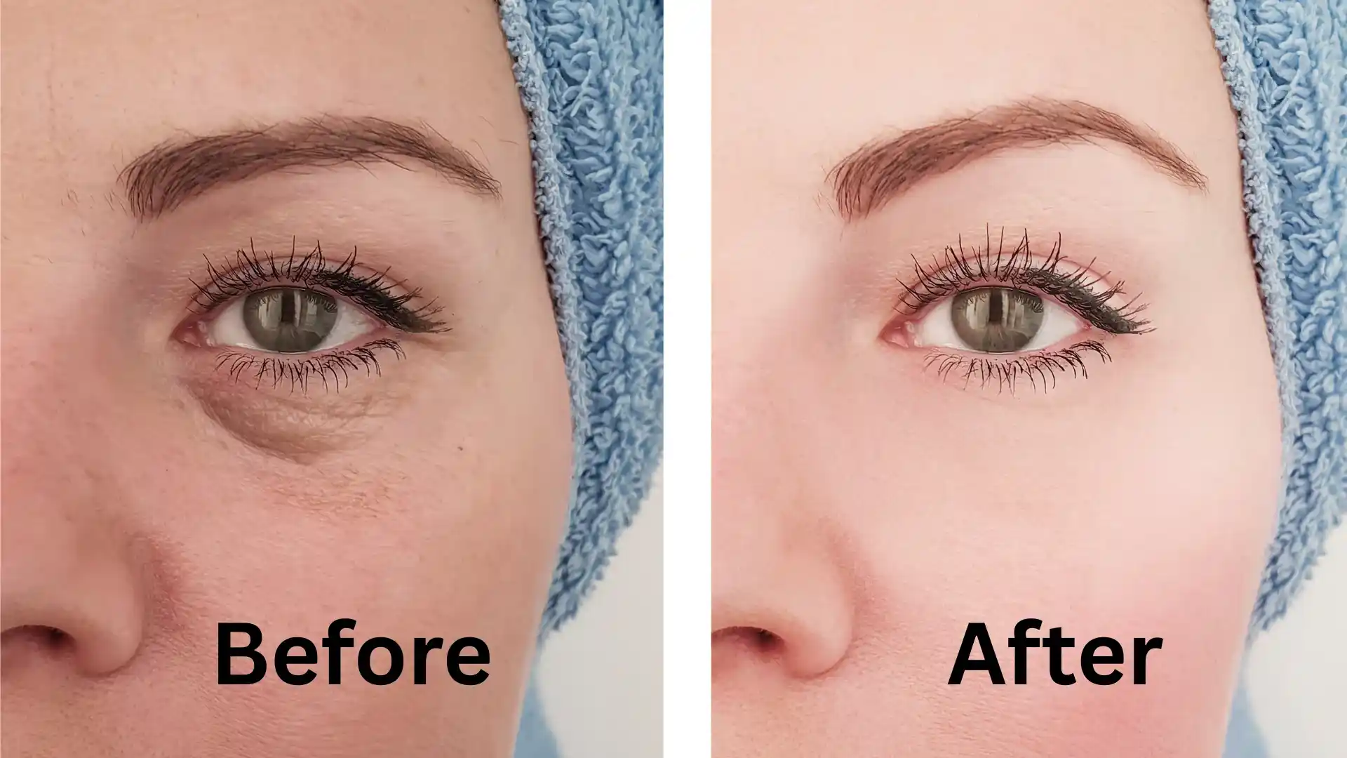 Under - Eye Dark Circle Treatment by Whimsy Aesthetic Clinic